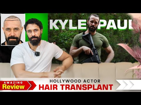 Hollywood Actor @kyle_paul Hair Transplant Journey | Amazing Hair Transplant Results in India