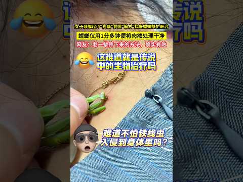 女子頸部起了"肉瘊"參照"偏方"找來螳螂幫忙醫治，螳螂僅用1分多鐘便將肉瘊處理乾淨，網友：老一輩傳下來的方法，確實有效！#shorts