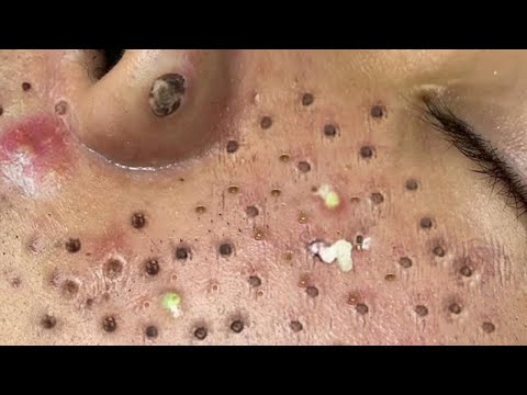 Blackhead Removal With Sac Dep Spa @100074094