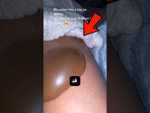 لا تلمس هذه الفقاعات أبدا !! ??
