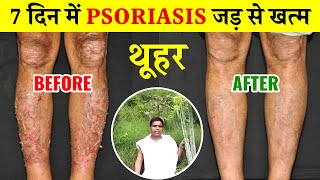 डंडा थोर के पेड़ से पा सकते हैं Psoriasis से हमेशा के लिए छुटकारा | thor ka ped | thuhar ke fayde