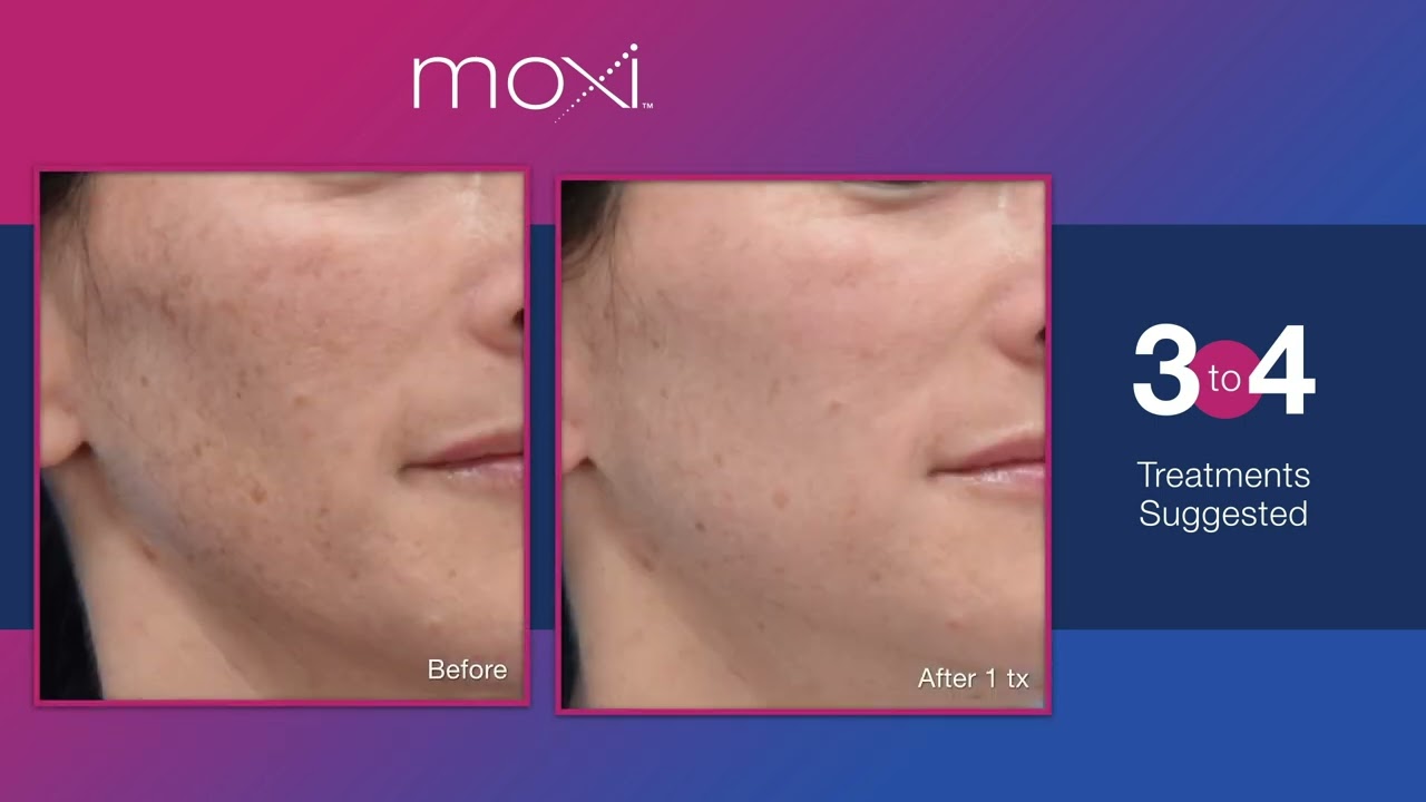 Skin treatment results before and after one session
