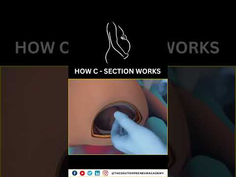 Cesarean Section Explained: Why Doctors Choose C-Sections for a Safer Birth 👶✂️ #Cesarean #Birth