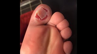 he shouldn't HAVE popped it..