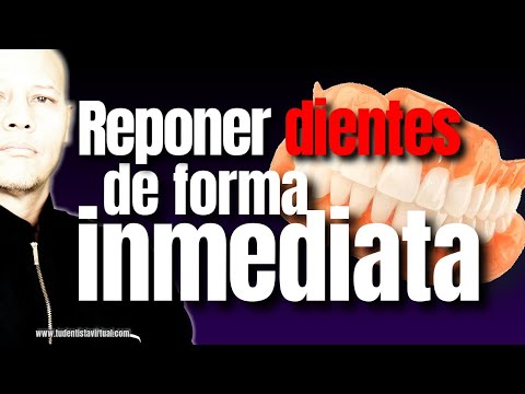 Los IMPLANTES DENTALES han CAMBIADO, ya no se hacen como ANTES