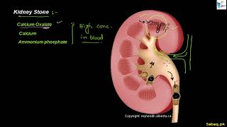 Kidney Stone