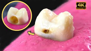 GIGANTE caries siendo removida en GRAN aumento 4K - Caries en microscopio