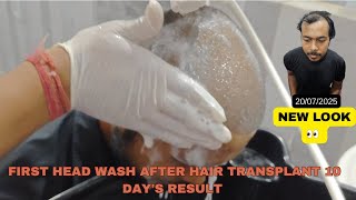 First Head wash After Hair Transplant 10 Day's Result  #hairtransplant 