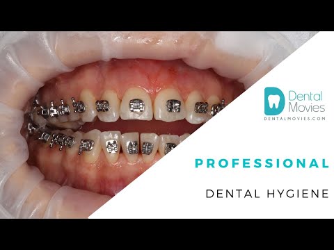 Professional dental hygiene