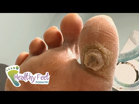 DEEP SATISFYING CALLUS TREATMENT