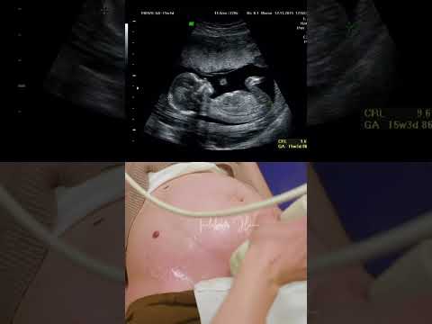 കുഞ്ഞിനെ ആദ്യമായി ultrasound സ്കാനിൽ കണ്ടപ്പോൾ കണ്ണ് നിറഞ്ഞോ🥺❤️#malayalam #pregnancy #fetusgrowth