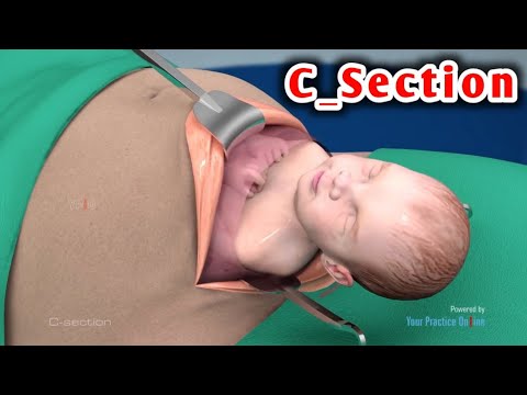 عملية الولادة القيصرية كاملة Watch the caesarean section