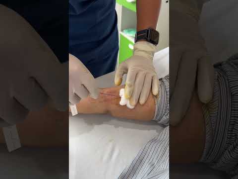 PICC Line Removal | Last Day of Chemotherapy