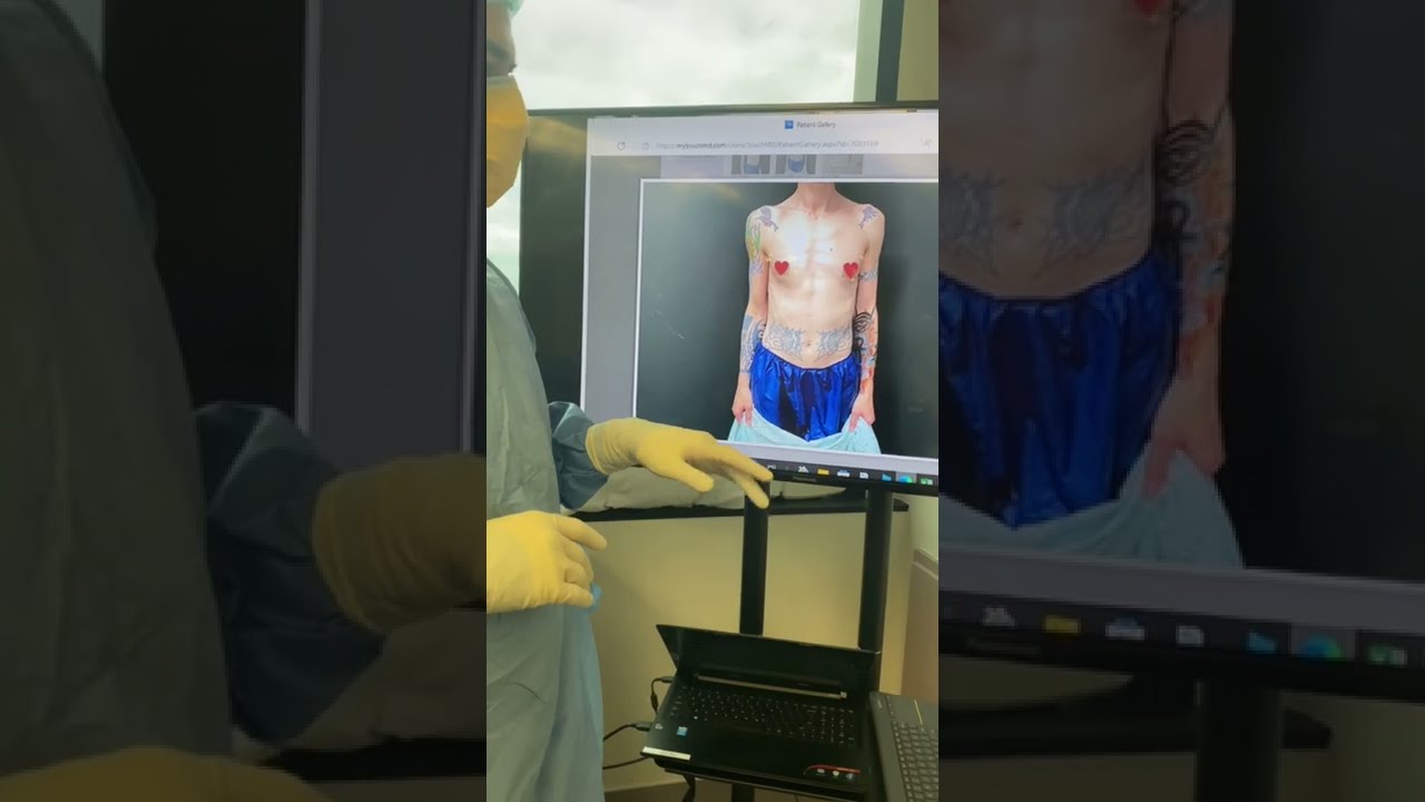 This video may be inappropriate for some users.
Transgender Breast Augmentation - 440cc Implants UNDER The Muscle! Full Surgery