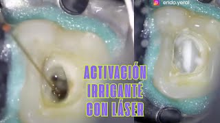 Activación del Irrigante con Láser 💦 🦷