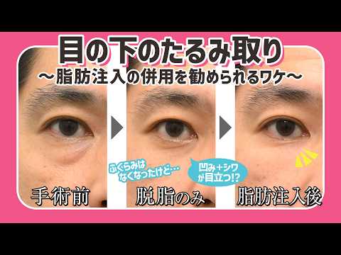 【目の下のクマ取り】ふくらみ取りだけでも問題ない？脂肪注入のありなしを比較してみた！【メンズ・たるみ取り】