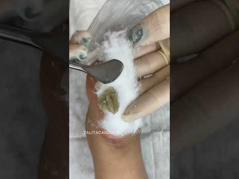 “Primeira sessão do spa dos pés concluÃda! O resultado ainda não ficou 100%, mas já está incrÃvel!