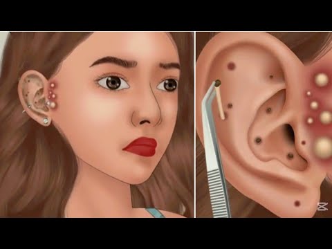 animation 《ASMR》Removing blackheads and sebaceous cysts from the ear