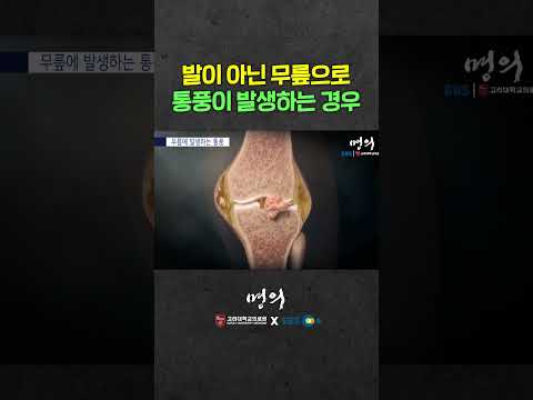 무릎으로 통풍이 찾아오는 경우