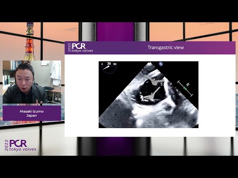The tricuspid valve: from diagnosis to repair. An Asian perspective – Webinar
