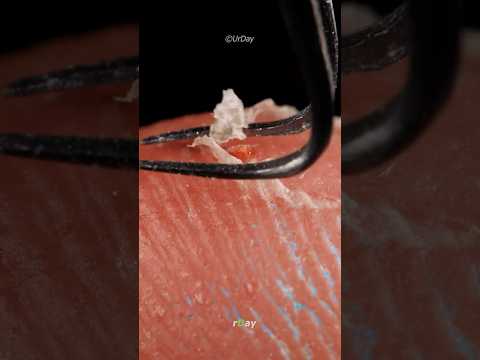 Finger Splinter Pulling Out Close-up #satisfying #urday #asmr