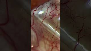 Microcirculación en vasos conjuntivales 👁️
