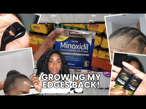 1 MONTH UPDATE! Minoxidil Edges Journey, How I Conceal, Progress and More!