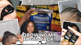 1 MONTH UPDATE! Minoxidil Edges Journey, How I Conceal, Progress and More!