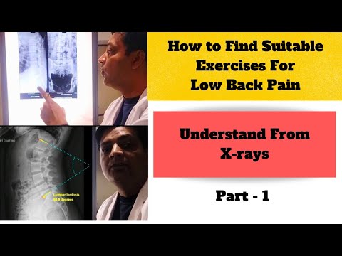 Suitable Exercises for Low Back Pain - Understand from X-rays ! Flexion Exs or Extension Exs Part 1