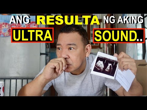 TAKOT ako sa SAKIT sa PROSTATE, nagpaULTRASOUND ako... Eto po ang RESULT!🙏😯 +ang E-BIKE. ni JOSEPH.