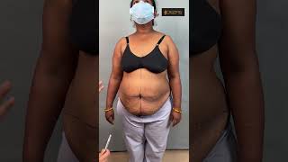 Tummy Tuck and back Liposuction Marking