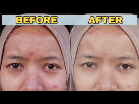 Hanya 7 hari ❗️Mengatasi jerawat & kemerahan dengan cepat !