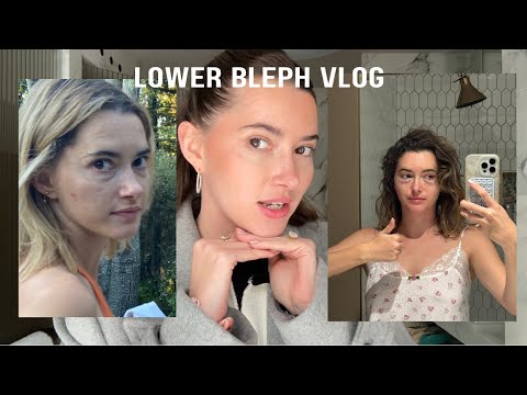 I got plastic surgery!! Lower blepharoplasty vlog