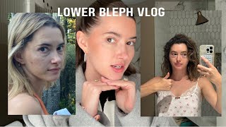 I got plastic surgery!! Lower blepharoplasty vlog