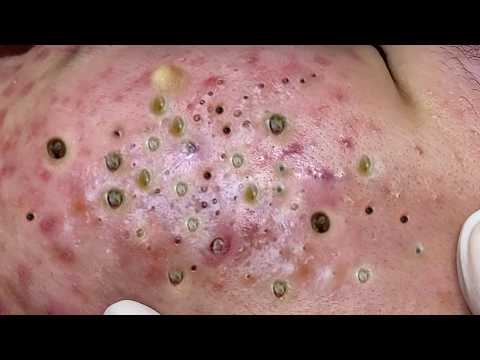 𝑪𝒚𝒔𝒕𝒊𝒄 𝑨𝒄𝒏𝒆 𝑹𝒆𝒎𝒐𝒗𝒂𝒍 & 𝑰𝒏𝒇𝒍𝒂𝒎𝒎𝒂𝒕𝒐𝒓𝒚 𝑨𝒄𝒏𝒆 #𝟖𝟔𝟖𝟔𝟖𝟏