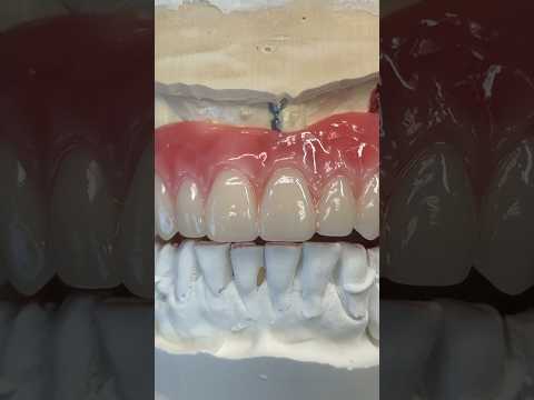 Hybrid Scree-Retained Wax Try-In for Dr. James Kim in Wisconsin