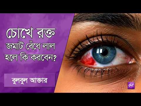 চোখের রক্ত জমাট বেঁধে লাল হয়ে যায় | Subconjunctival Hemorrhage | Bleeding in Eye | Goodie Life