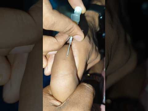 IV Cannulation technique video #mbbs #shortvideo