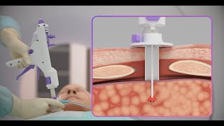 Breakthrough image-guided technology for cancer - 3D animation