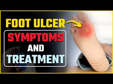 Diabetic Foot Ulcers | लक्षण और उपचार | Foot Ulcer Treatment at Home