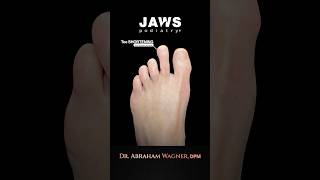 WAIT FOR IT!😳#toeshortening #toeshorteningsurgery #acortamientodelosdedos