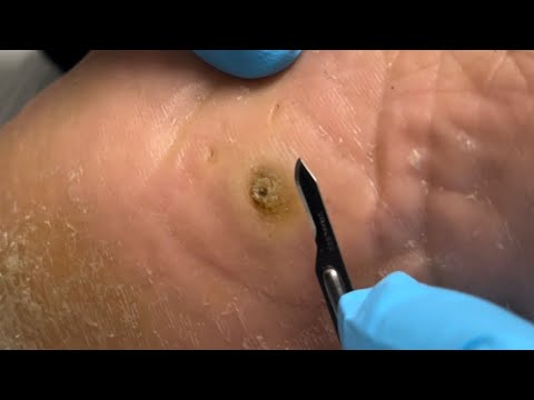 GET THIS HEEL SPUR OUT OF MY FOOT!