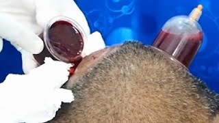 Bekam Kepala,mata jadi terang dan jantung lega