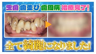 【虫歯、歯周病】ボロボロ・グラグラからの復活‼️