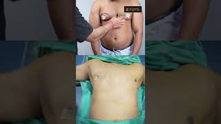 One-Sided Gynecomastia Surgery