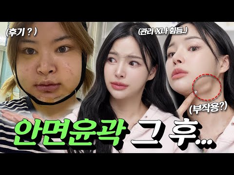 안면윤곽 하고 후회하냐고?;;솔직후기요..😢ft.부작용/n천만원날림?💸