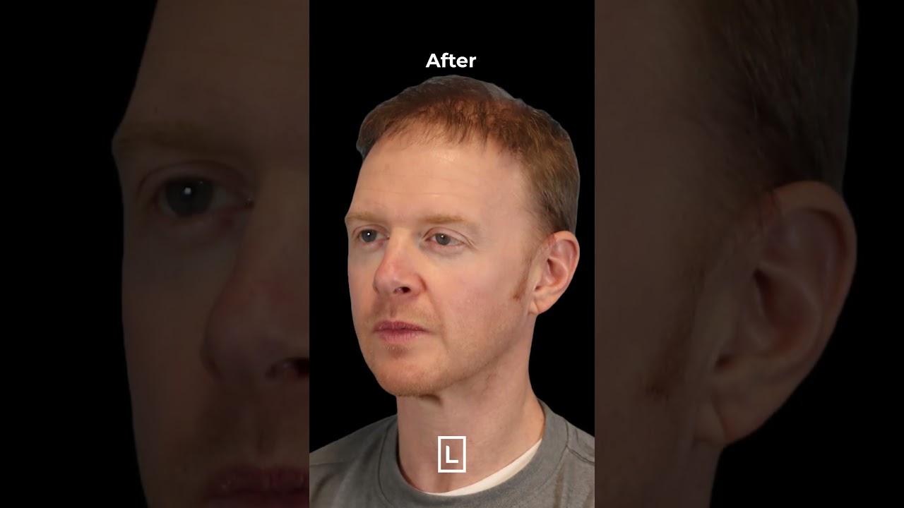 Hair Transplant video