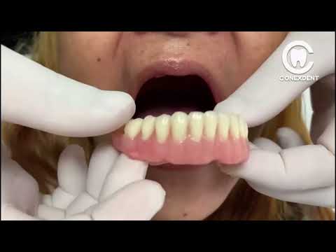 DENTAL PROSTHESIS without ACRYLIC on the LIP 😱😱😱