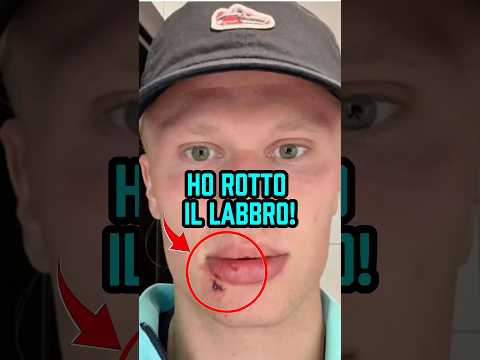 Ma cosa è successo al labbro di Haaland ? Rimarrai sorpreso nel saperlo 😱