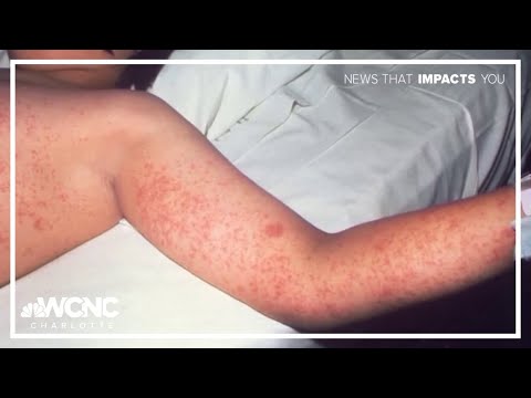 YouTube video thumbnail: South Carolina Confirms First Measles Case Since 2024 in Unvaccinated Traveler